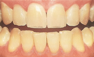 Pictures Of Teeth Stained From Coffee And Tea 22