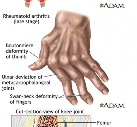 rheurmatoid arthritis hands NIH