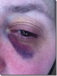 black eye