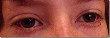 eyes_after_strabismus_surgery